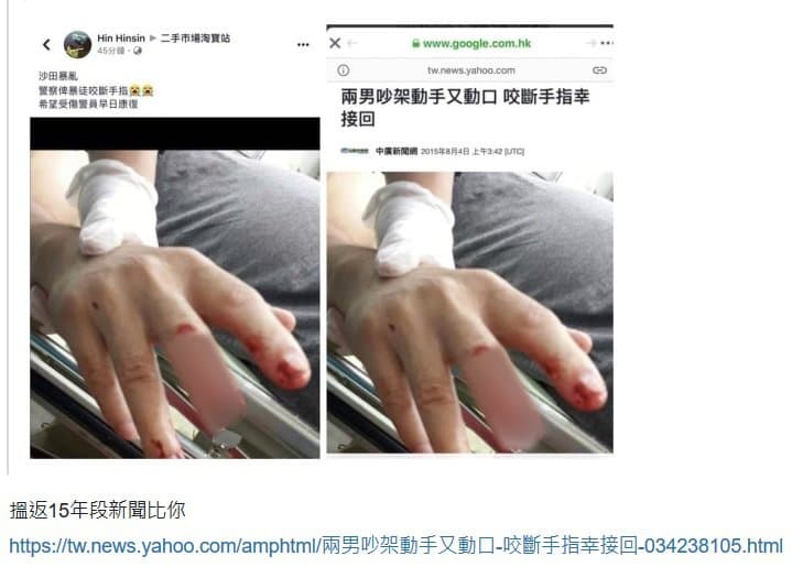 社交媒體帖文與舊新聞報道的對照截圖,顯示同一張手部受傷照片曾出現於較早年份的新聞